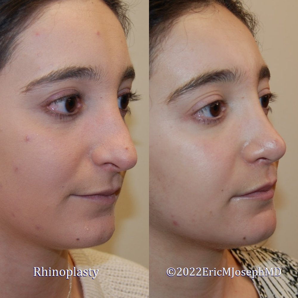 The Nose job before and after results are fully guaranteed. post thumbnail image