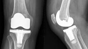 Exactech Knee Implant Recall Lawsuit post thumbnail image