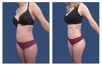 What exactly is the function of liposuction surgery? post thumbnail image