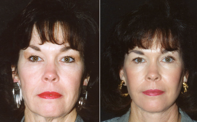 Is eyelid surgery Santa Barbara surgical treatment excellent? post thumbnail image